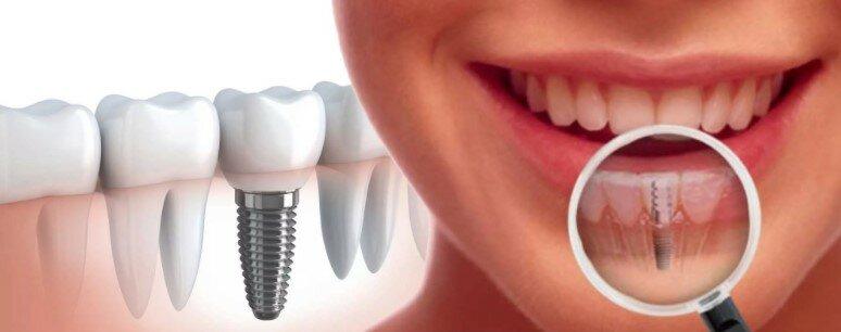 Зубные имплантаты: стоит ли платить так дорого