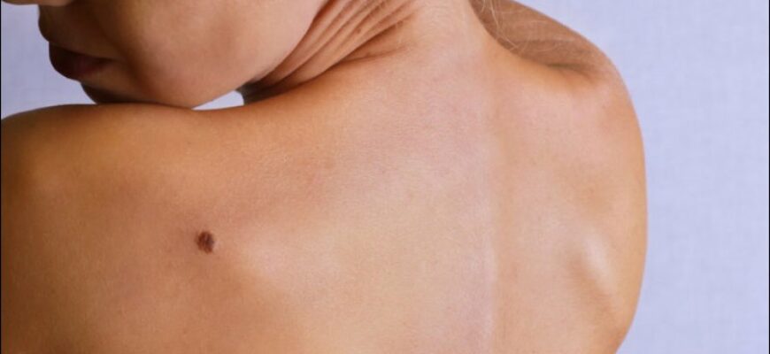 Какое бывает лечение меланомы кожи?