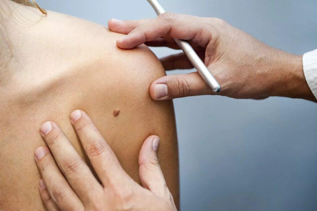 Какое бывает лечение меланомы кожи?