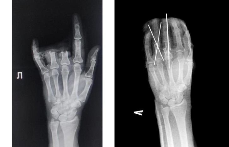 Врачи из Каширы за 2,5 часа зашили мужчине пальцы, порезанные болгаркой
