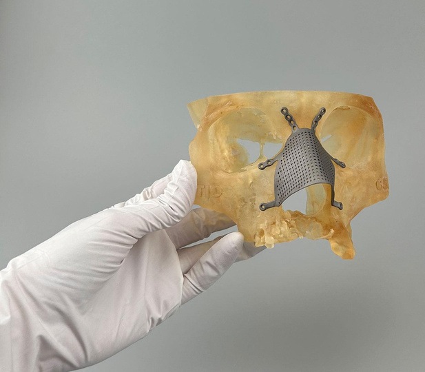 Врачи из Самары на 3D-принтере напечатали новый нос человеку, потерявшему этот орган