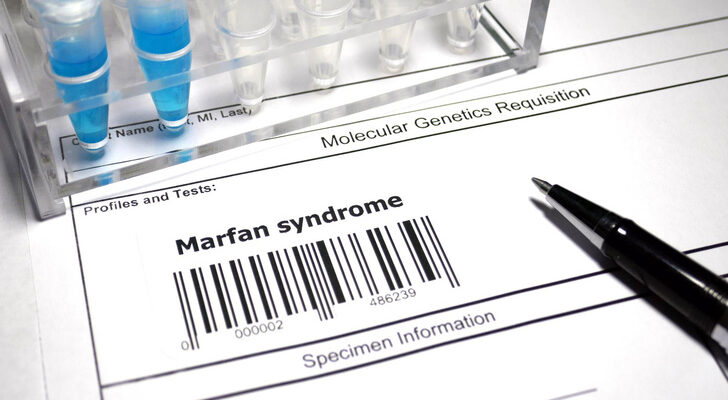 «Болезнь гениев»: врач рассказала, как выглядит человек с синдромом Марфана