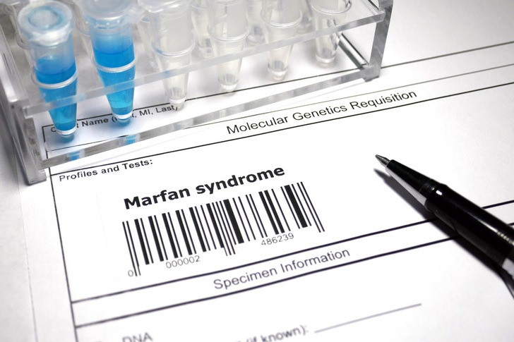 «Болезнь гения»: врач объяснил, как выглядит человек с синдромом Марфана