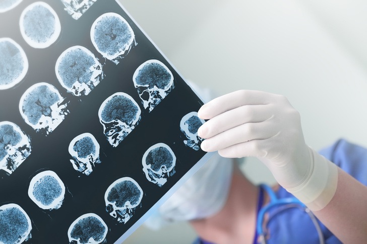 Последствия для мозга необратимы: герпес может спровоцировать болезнь Альцгеймера (исследование)