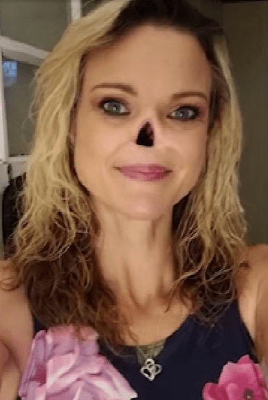 Женщина потеряла нос из-за рака и теперь ходит с дыркой на лице