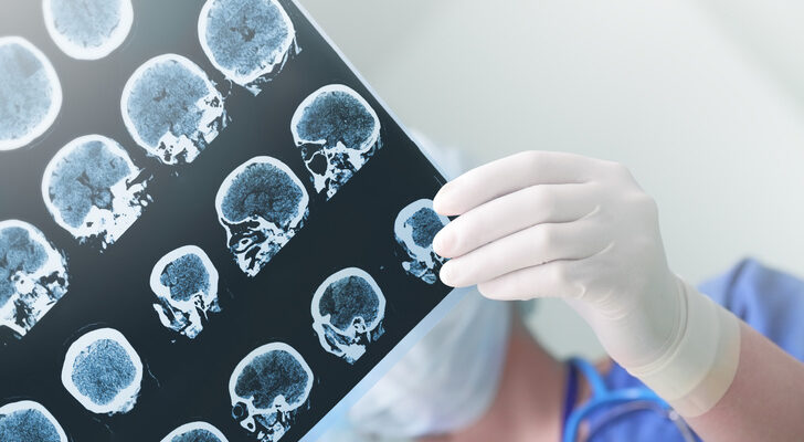 Университет Линчепинга: «У людей с постковидным синдромом изменилось строение мозга»