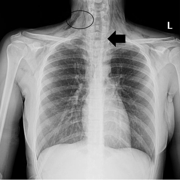 52-й случай в мире: девочка не может дышать из-за опухоли нервных клеток в груди