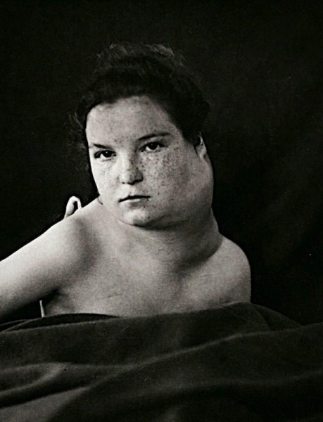 Портреты боли: замечательные фотографии пациентов XIX века, страдающих от серьезных заболеваний