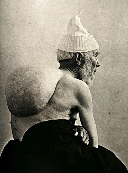 Портреты боли: замечательные фотографии пациентов XIX века, страдающих от серьезных заболеваний