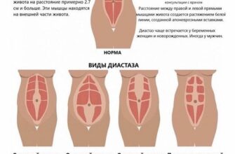 ДИАСТАЗ ПРЯМЫХ МЫШЦ ЖИВОТА