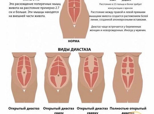 ДИАСТАЗ ПРЯМЫХ МЫШЦ ЖИВОТА