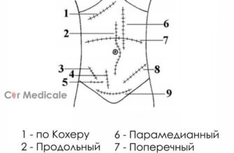 1. Доступ по Кохеру - доступ к желчным путям и печеночному углу толстой кишки- ко...