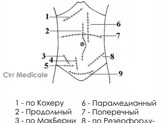 1. Доступ по Кохеру - доступ к желчным путям и печеночному углу толстой кишки- ко...