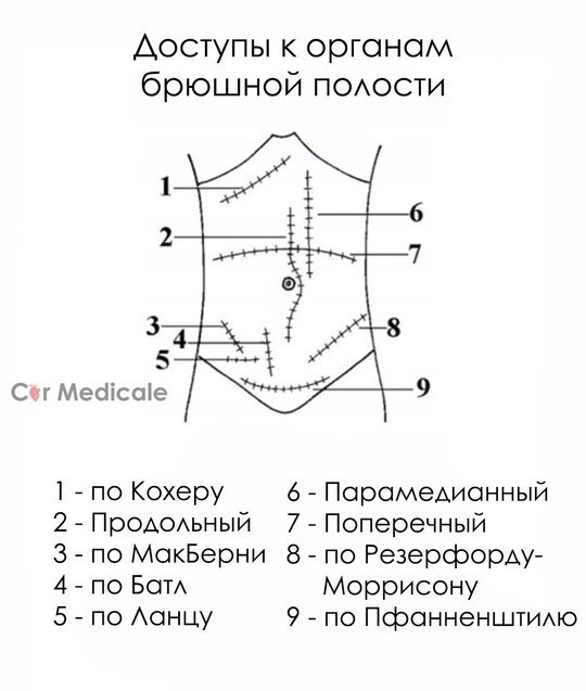 1. Доступ по Кохеру - доступ к желчным путям и печеночному углу толстой кишки- ко...
