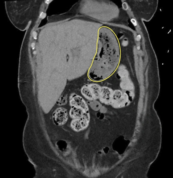 Ну и методы: врачи вылечили тошноту у женщины, напоив ее диетической колой Ну и методы: врачи вылечили тошноту у женщины, напоив ее диетической колой